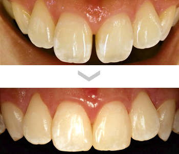 上顎中切歯の正中離開をダイレクトボンディング法にて改善した症例